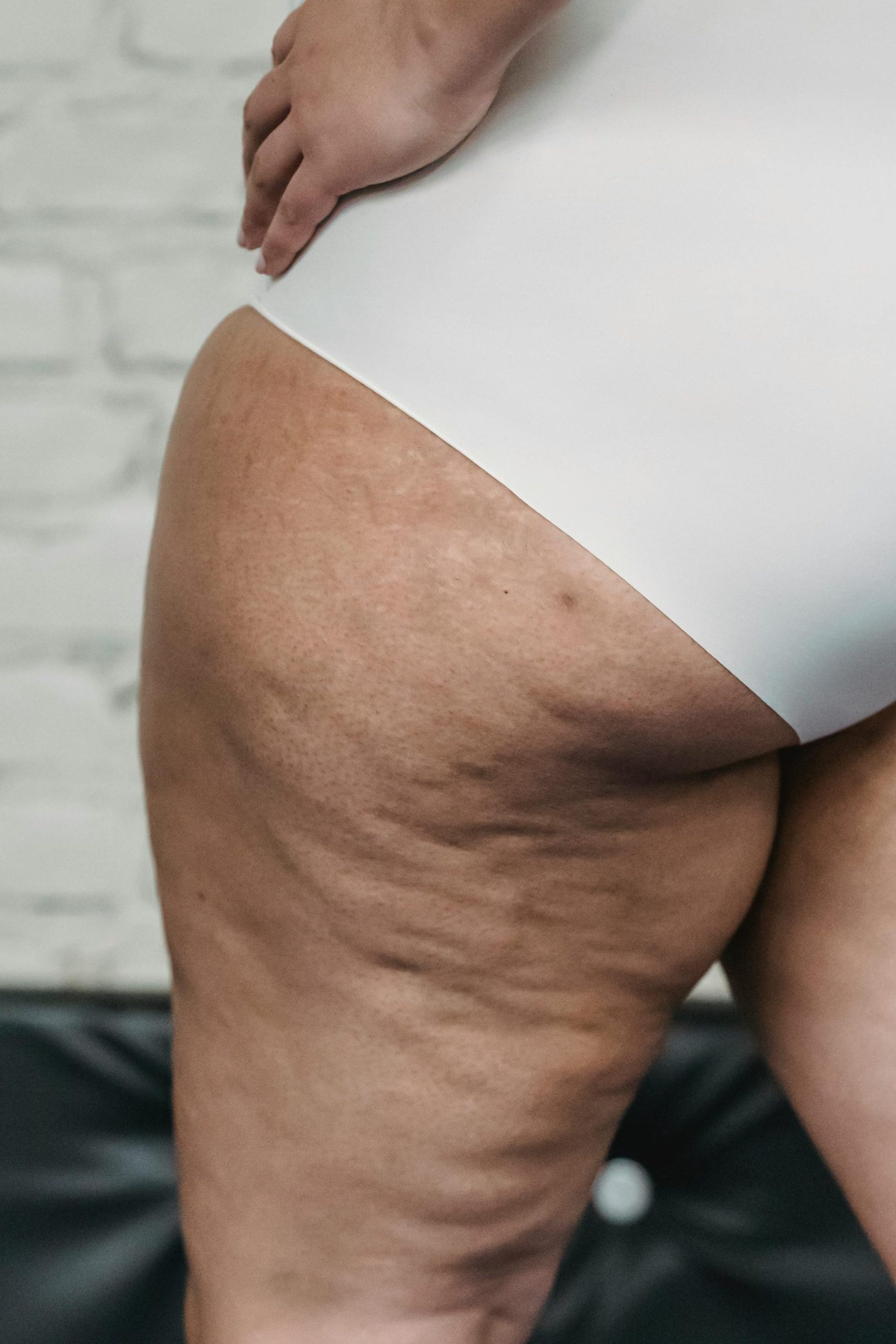 Lipedema y nutrición: abordaje nutricional personalizado